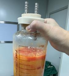 哈尔滨水动力吸脂手术要做多久？